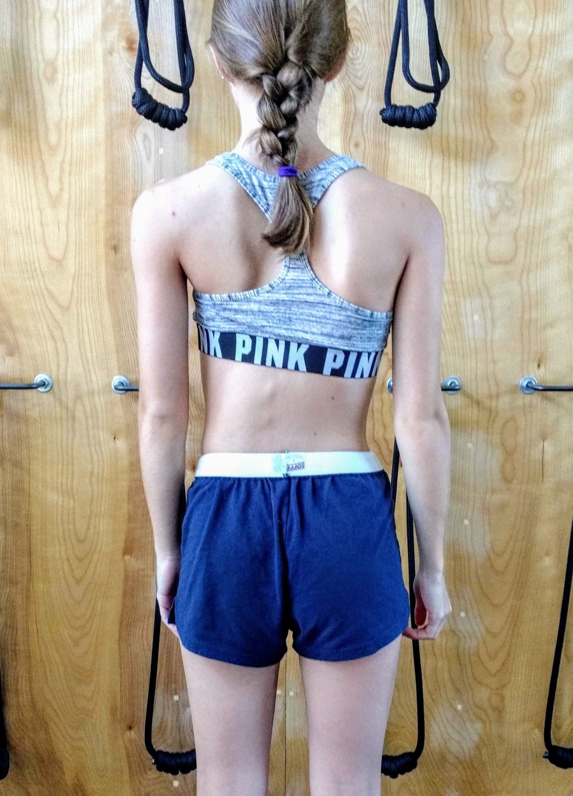 scoliosis