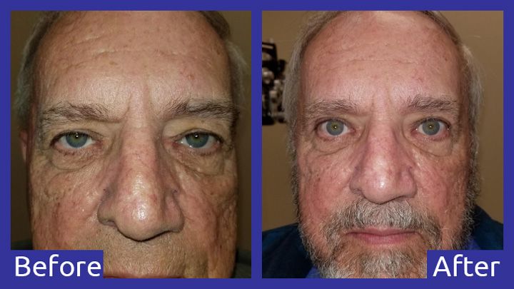 A before and after photo of a man 's face.