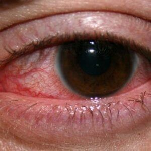 A close up of a person 's red eye.