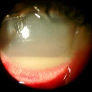 A close up of a person 's eye with a microscope.