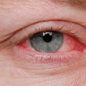 A close up of a person 's eye with red eyes.