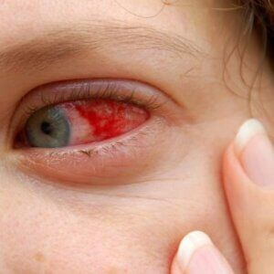 A close up of a woman 's red eye with a green pupil
