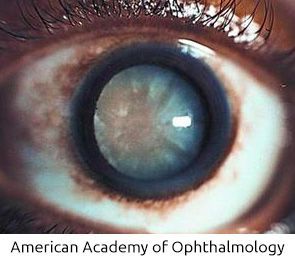A close up of a person 's eye from the american academy of ophthalmology