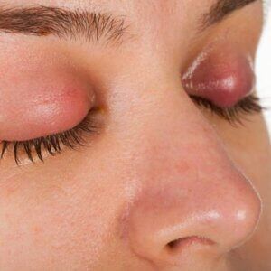 A close up of a woman 's face with a red eye.