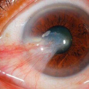 pterygium surgery