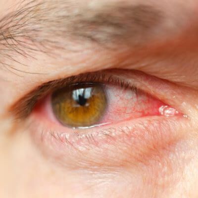 close-up of a man with an irritated eye