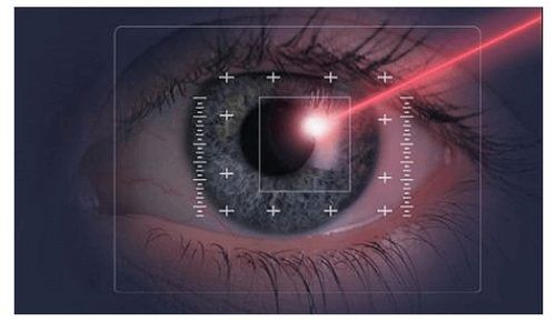 LASIK Eye Surgery