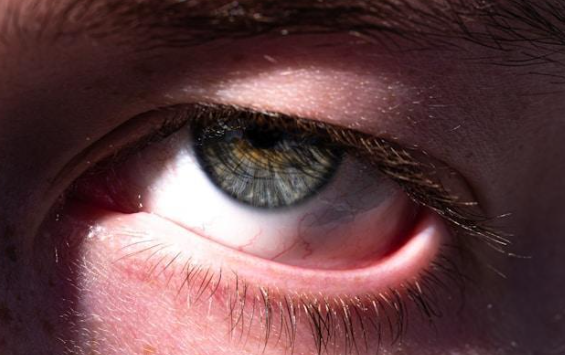 Recognizing and Treating Summer Conjunctivitis (Pink Eye) | Baptist Eye