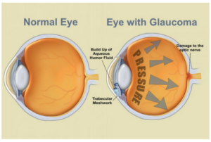 A diagram of a normal eye and an eye with glaucoma