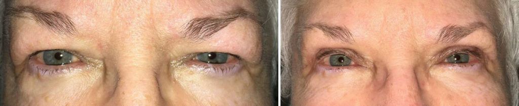 A before and after picture of a woman 's eyes.