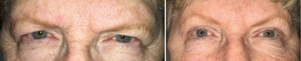 A before and after picture of a woman 's eyes.