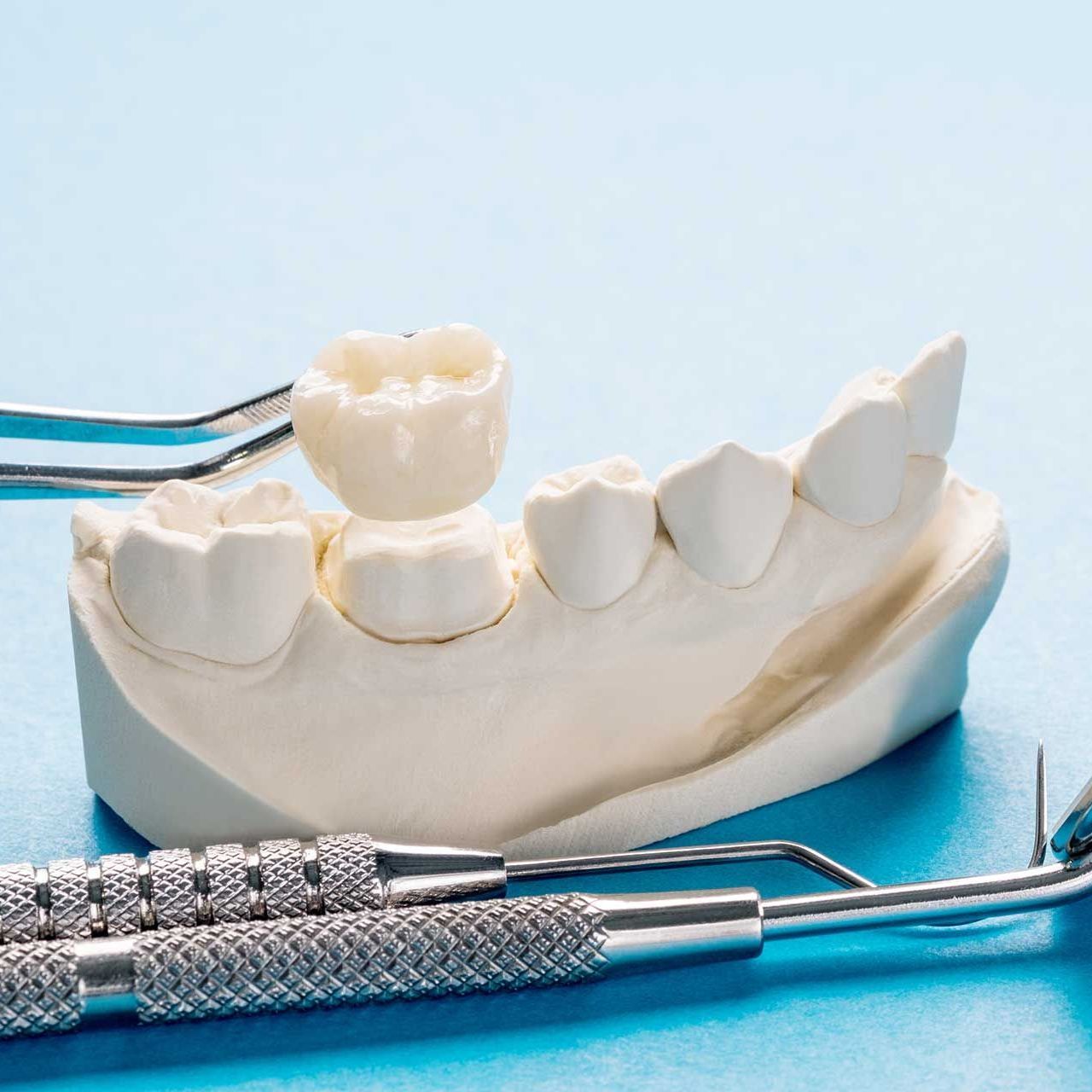 Single teeth crown and bridge