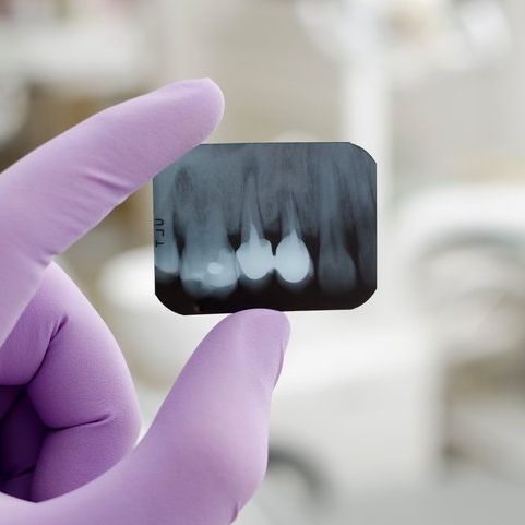 A person wearing purple gloves is holding an x-ray of their teeth