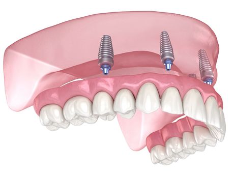 3D dental implant model showing upper jaw with three titanium implants and teeth set