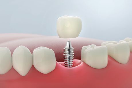 Dental implant with crown between white teeth and pink gums