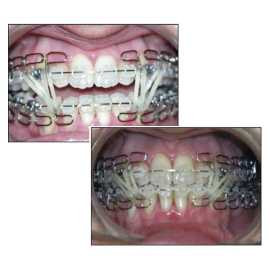 A before and after picture of a person with a MEAW technique