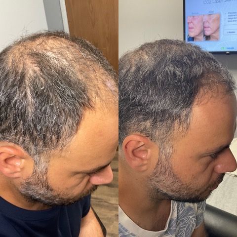 A before and after photo of a man's hair after PRP Treatment