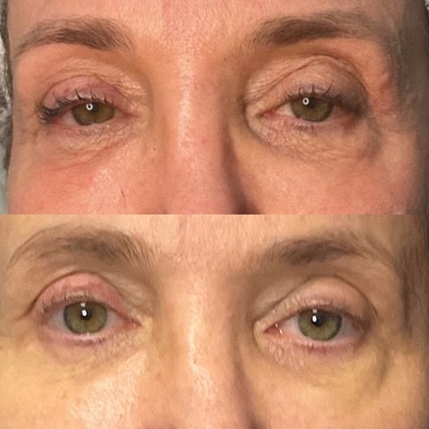 A before and after photo of a woman 's eyes after PRP Treatment.