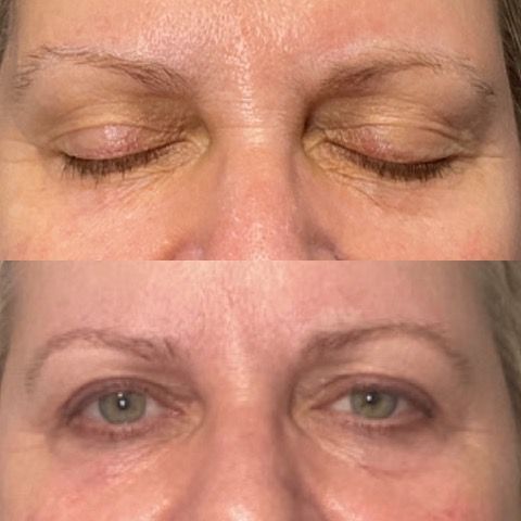 A before and after photo of a woman 's eyes after PRP Treatment.