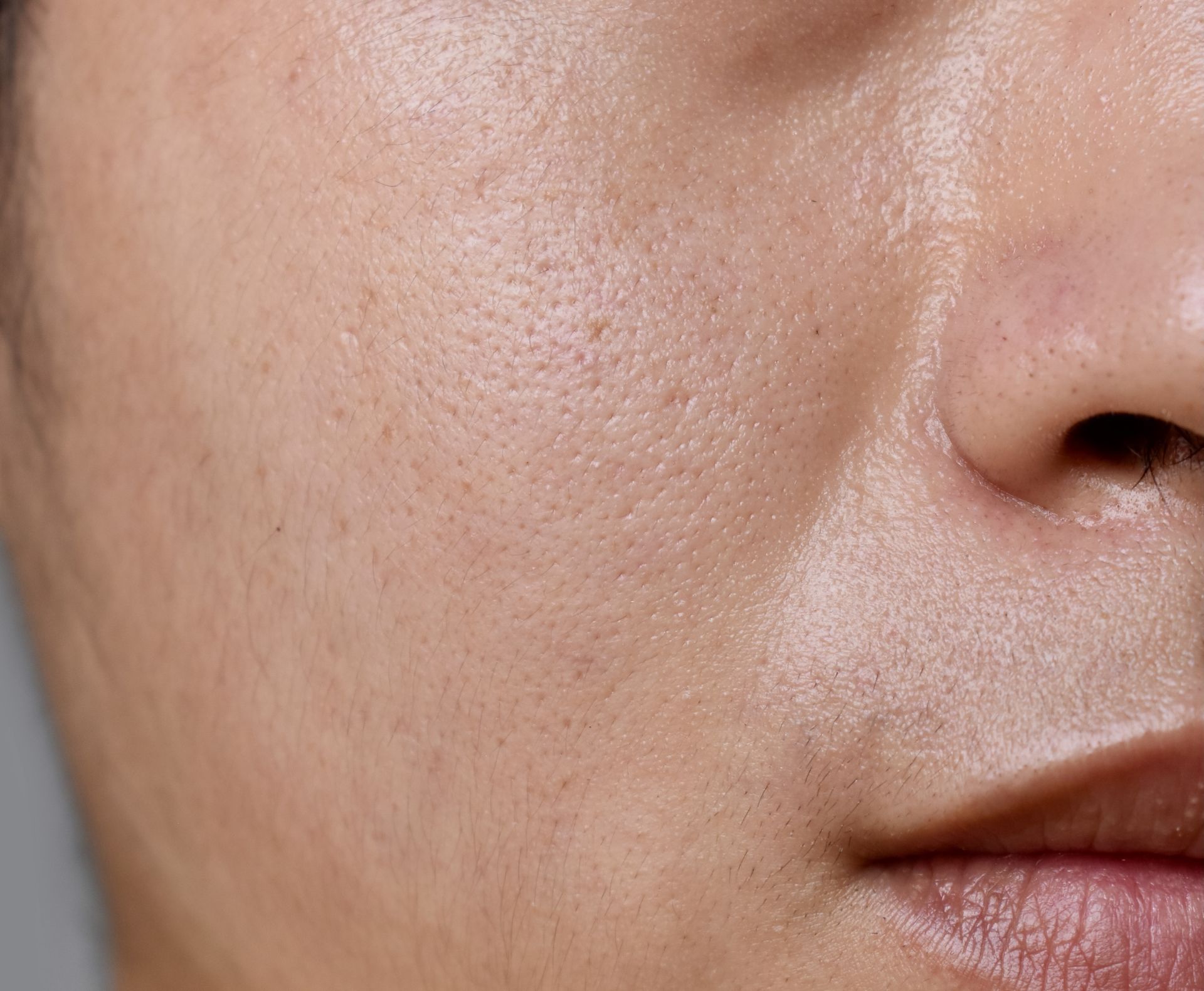 Enlarged pores