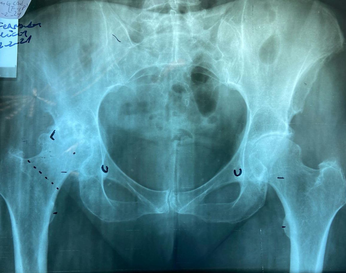 coxartrosis derecha