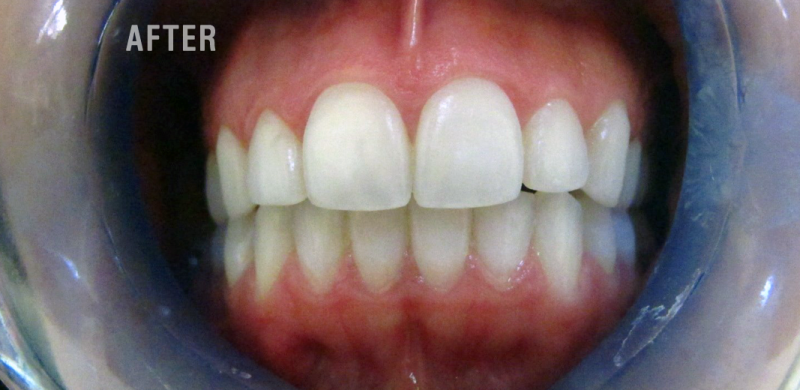 Teeth whitening special