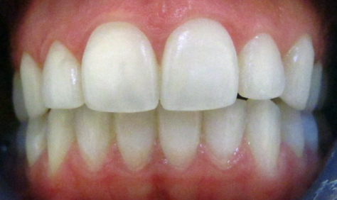 Teeth Whitening
