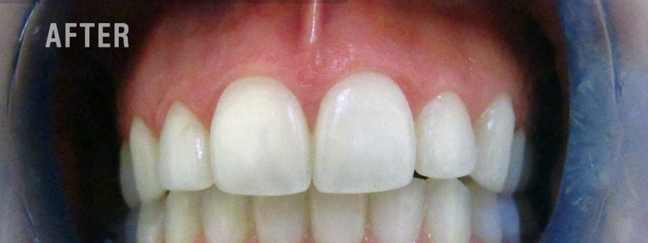 teeth whitening treatment