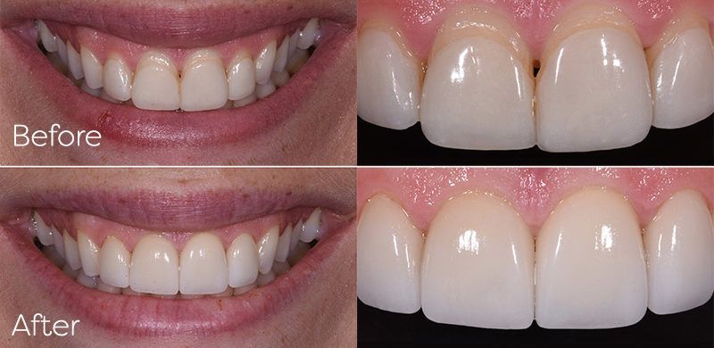 Replace Veneers