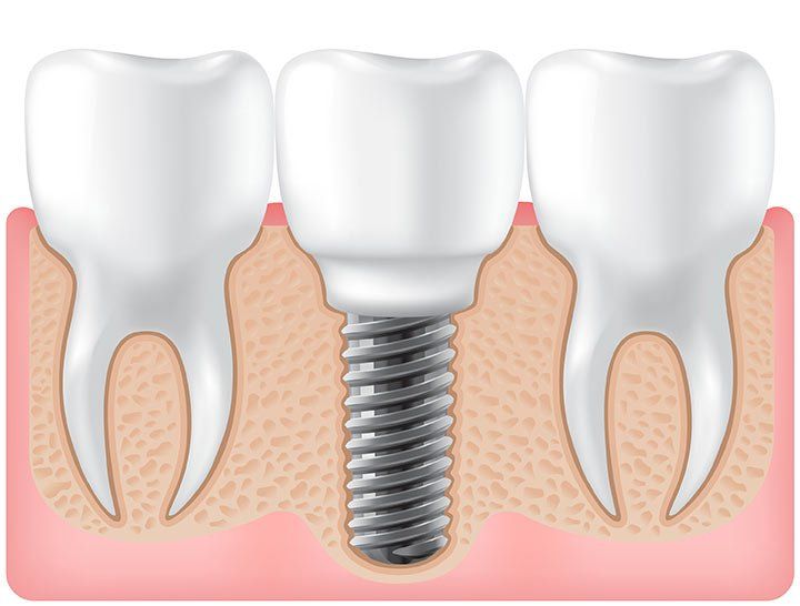 Dental Implants
