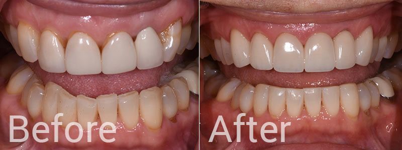 Dental Crowns