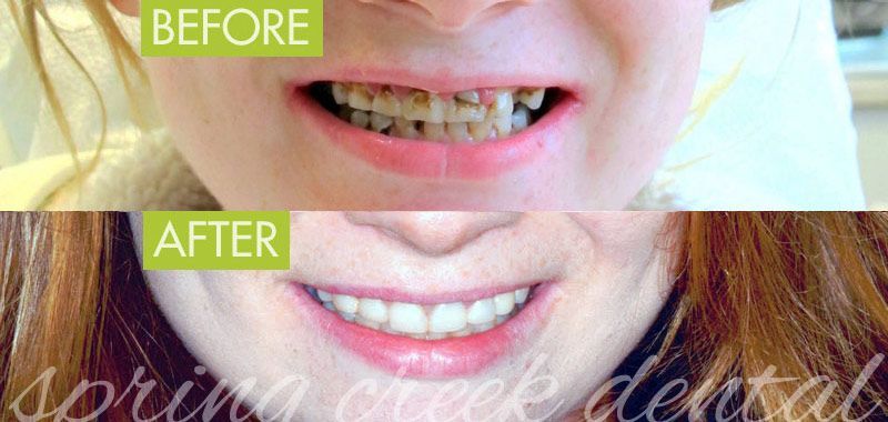 Before and After Composite Restoration
