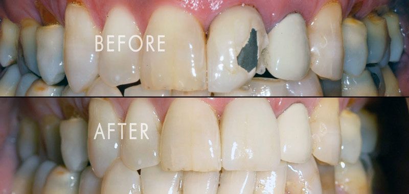 single tooth crown