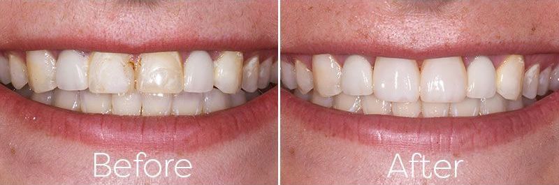 before after dental composites