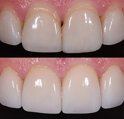 Veneers Replaced