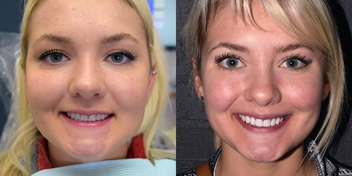 Porcelain Veneers