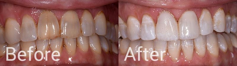 Tooth Whitening Composite Veneers