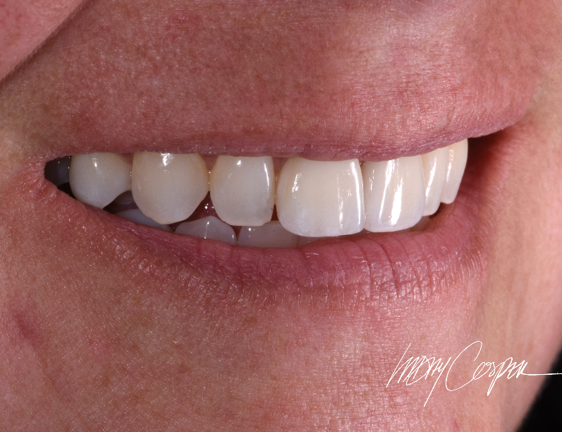 Final after photo of ceramic veneers smile makeover in Fort Collins CO