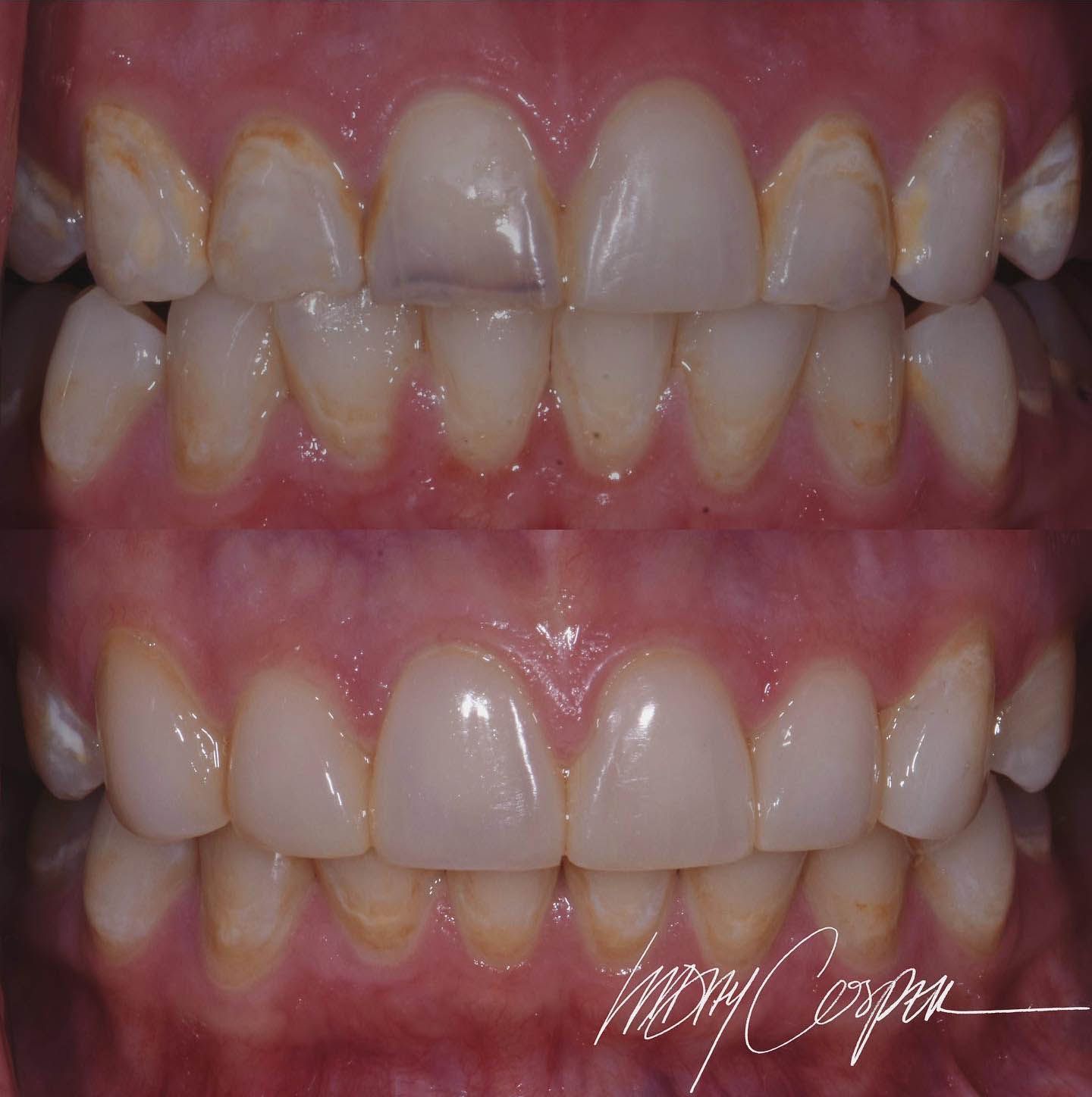 Composite Restorations