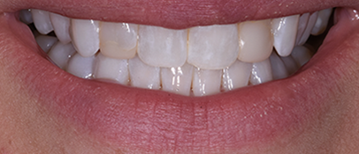 Composite Veneer Restorations