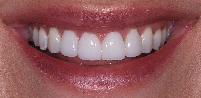 Cosmetic Porcelain Veneers