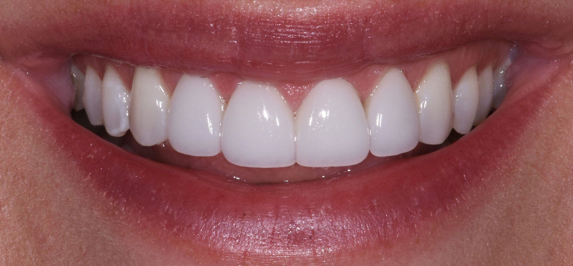Porcelain veneers