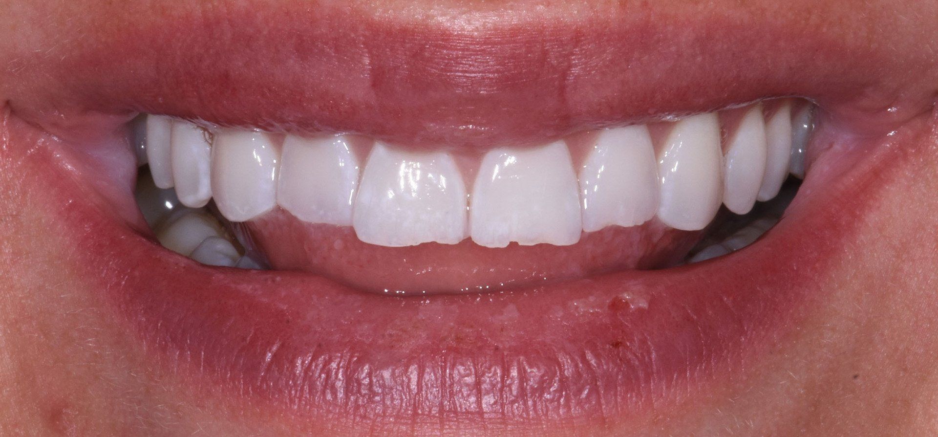 veneers dentists