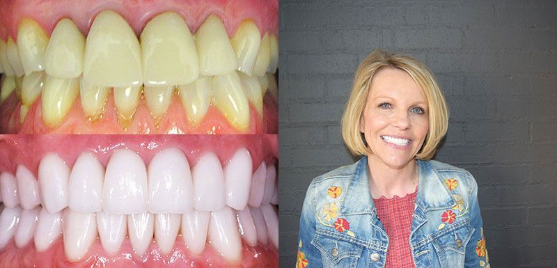 smile makeover veneers