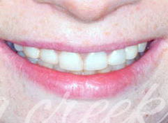 Single Tooth Implant Replacement