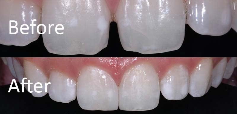 Diastema Closure Composite