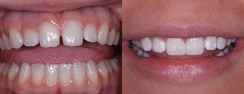 Diastema Closure Composite