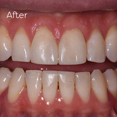 Diastema Gapped Teeth Closure