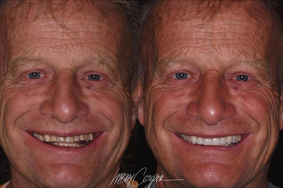 Patient's smile before and after receiving new dental crowns, showing improved shape, natural color, uniform smile.