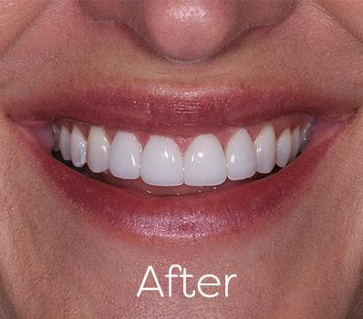 Ceramic Veneers